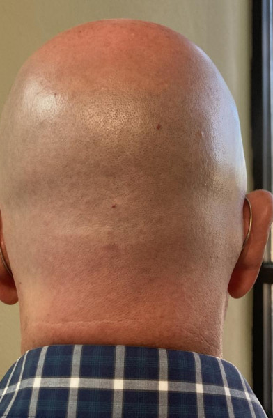 Baldguy